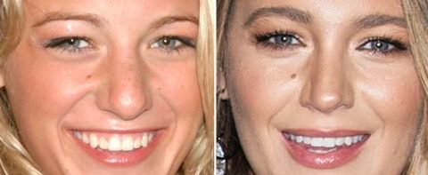 Celebrities Who Have Had Blepharoplasty Before and After