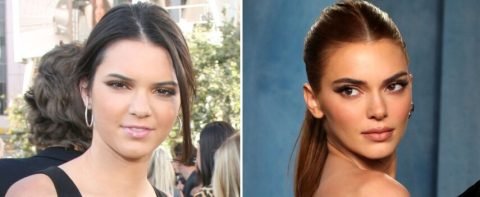 Celebrities Who Have Had Blepharoplasty Before and After