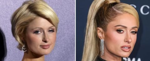 Celebrities Who Have Had Blepharoplasty Before and After