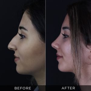 8 months after rhinoplasty