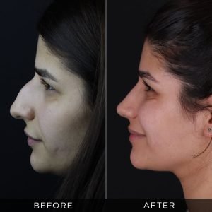 Rhinoplasty before and after 6 months
