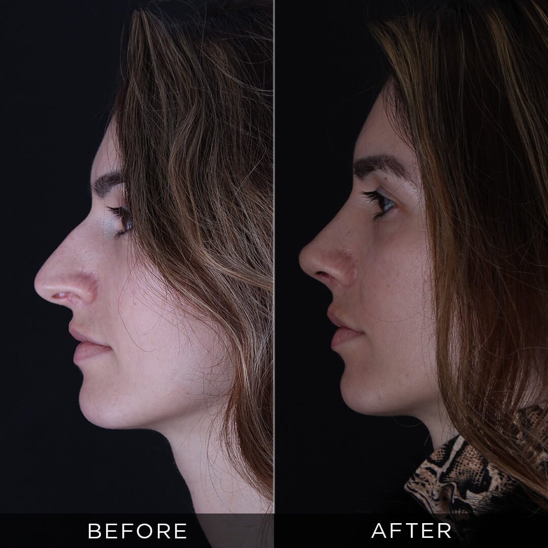 before and 6 months after rhinoplasty