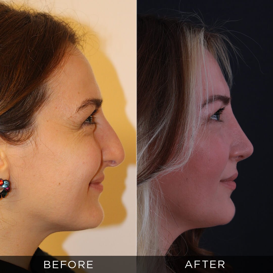 Rhinoplasty after 2 years