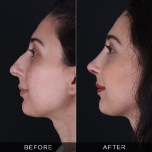 Rhinoplsty surgery after 1 years