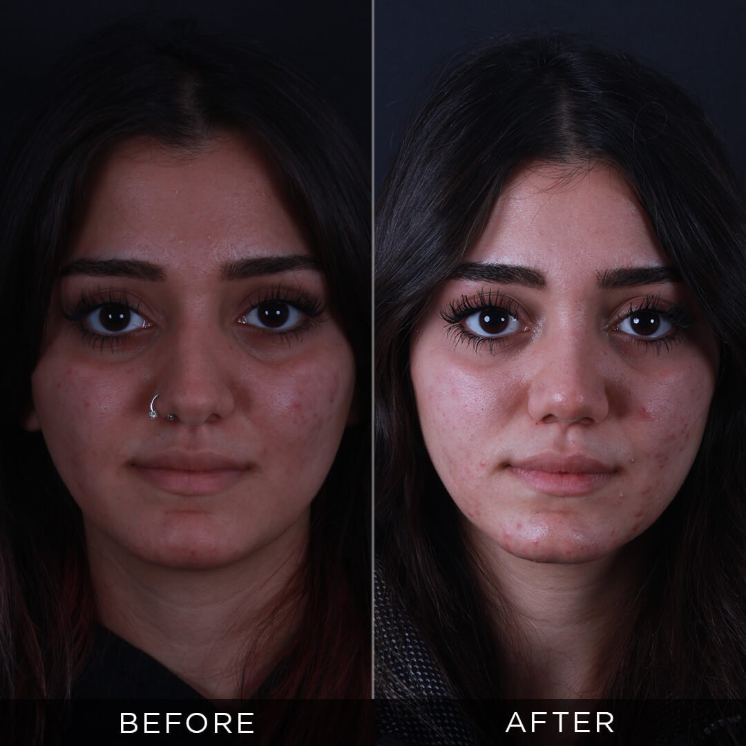 What Causes a Bulbous Nose Tip?