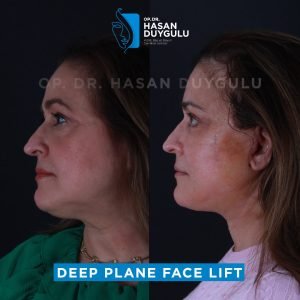 facelift pictures after 5 days