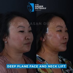 face-lift-before-and-after-turkey