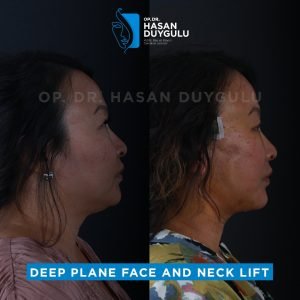 face-lift-before-and-after-turkey