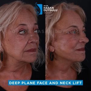 Facelift Before After Photos in Turkey