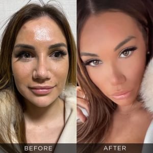 Facelift Before After Photos in Turkey