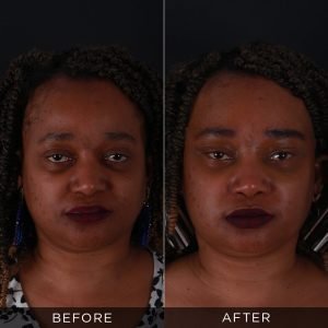 Eyelid Surgery Before After Photos in Turkey