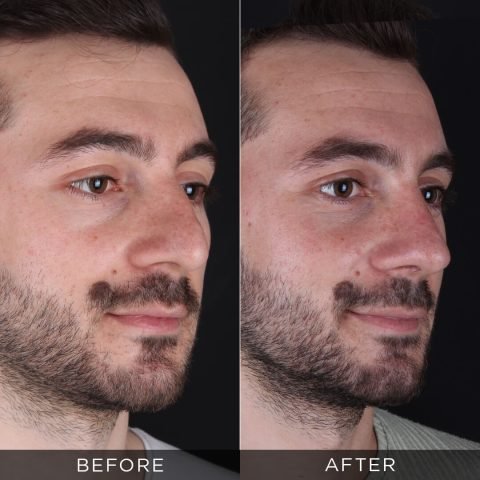 male-rhinoplasty-before-and-after-10