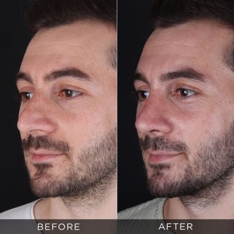 male-rhinoplasty-before-and-after-11