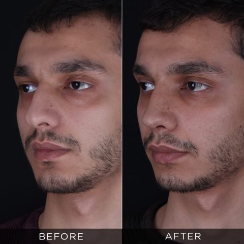 male-rhinoplasty-before-and-after-12