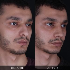 male-rhinoplasty-before-and-after-13