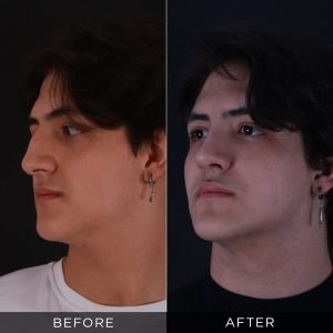 male-rhinoplasty-before-and-after-14