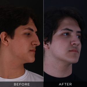 male-rhinoplasty-before-and-after-15