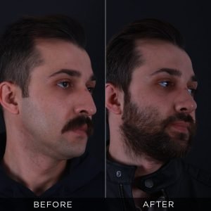 male-rhinoplasty-before-and-after-16