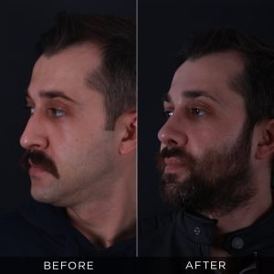 male-rhinoplasty-before-and-after-17