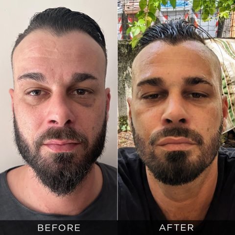 men-revision-rhinoplasty-before-after-turkey