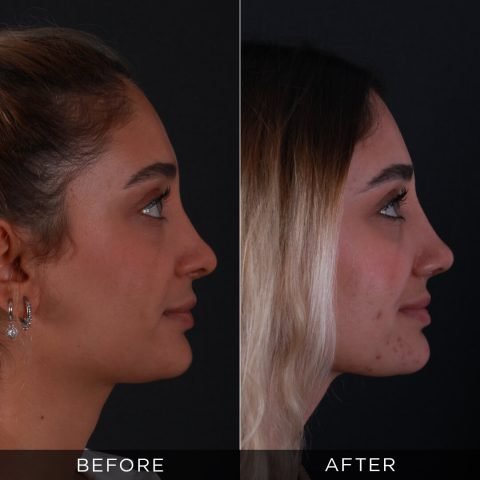 revision-rhinoplasty-before-after-4