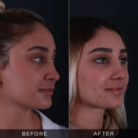 revision-rhinoplasty-before-after-5