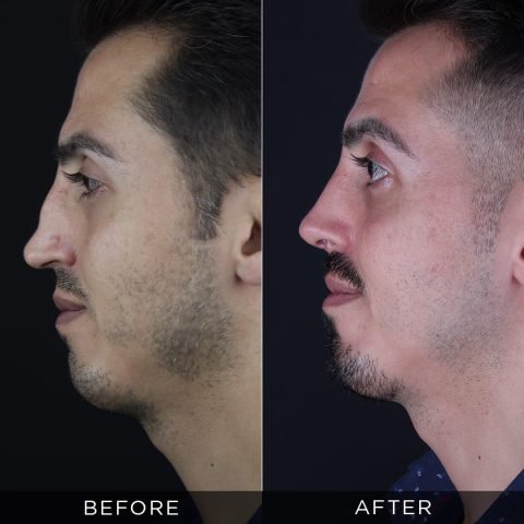 revision-rhinoplasty-before-and-after-11