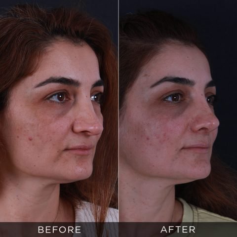 revision-rhinoplasty-before-and-after-3