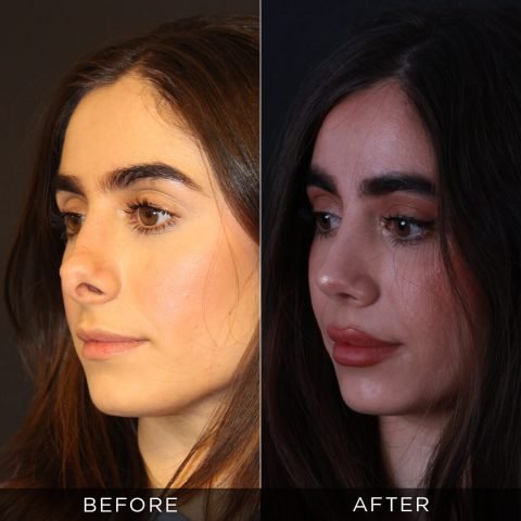 revision-rhinoplasty-before-and-after-4