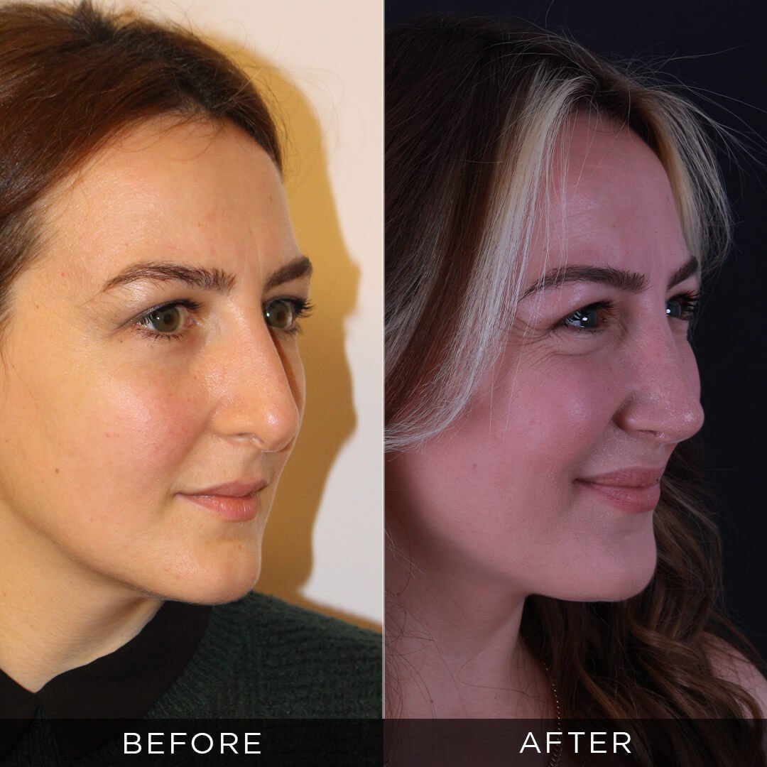 Rhinoplasty and 2 years post-op