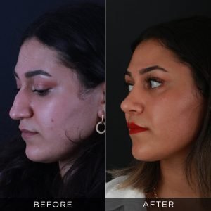 rhinoplasty-before-and-after-75