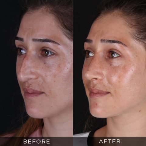 rhinoplasty-before-and-after-79