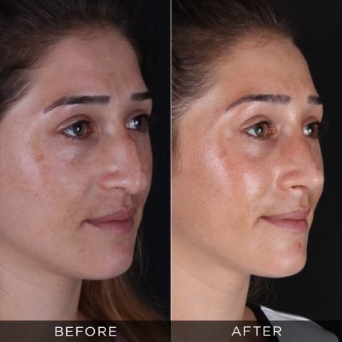 rhinoplasty-before-and-after-80