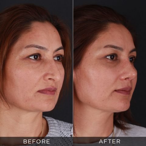 Rhinoplasty 1 month post op