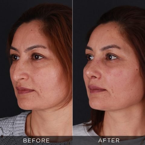 1 months post op nose job