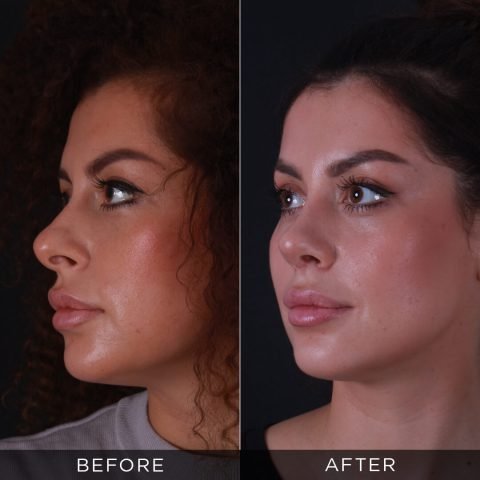 Nose job 6 months after