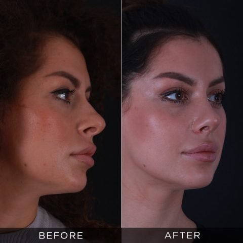6 Months post op nose job
