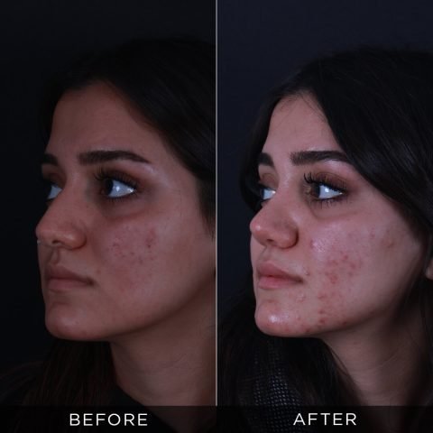 rhinoplasty-before-and-after-85