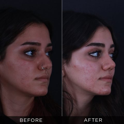 rhinoplasty-before-and-after-86