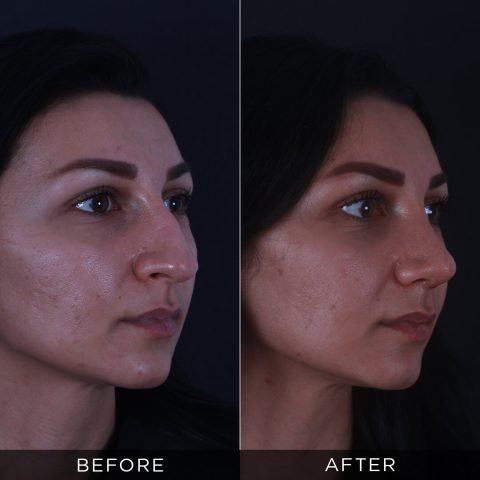 rhinoplasty-before-and-after-87