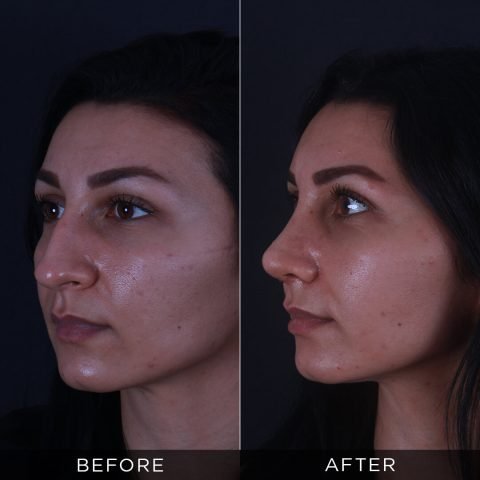 rhinoplasty-before-and-after-88