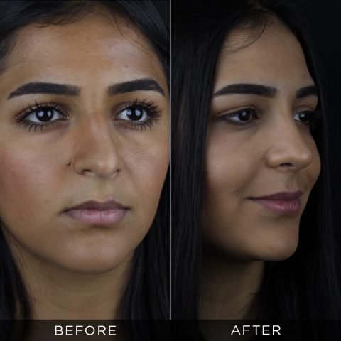 rhinoplasty-before-and-after-89
