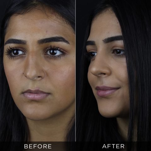 rhinoplasty-before-and-after-90