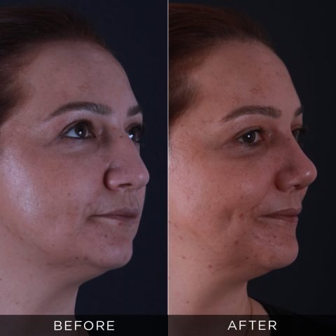 rhinoplasty-before-and-after-91