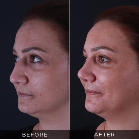 rhinoplasty-before-and-after-92