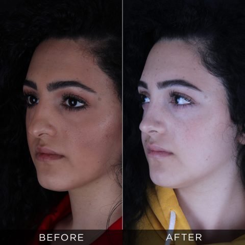 rhinoplasty-before-and-after-93