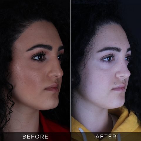 rhinoplasty-before-and-after-94