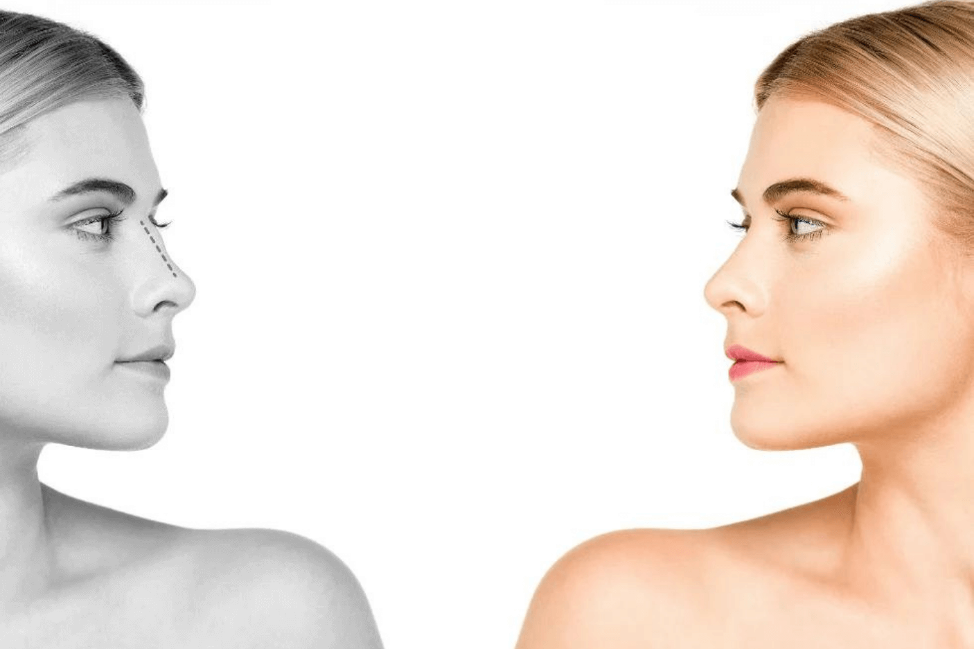 Rhinoplasty Techniques and Methods