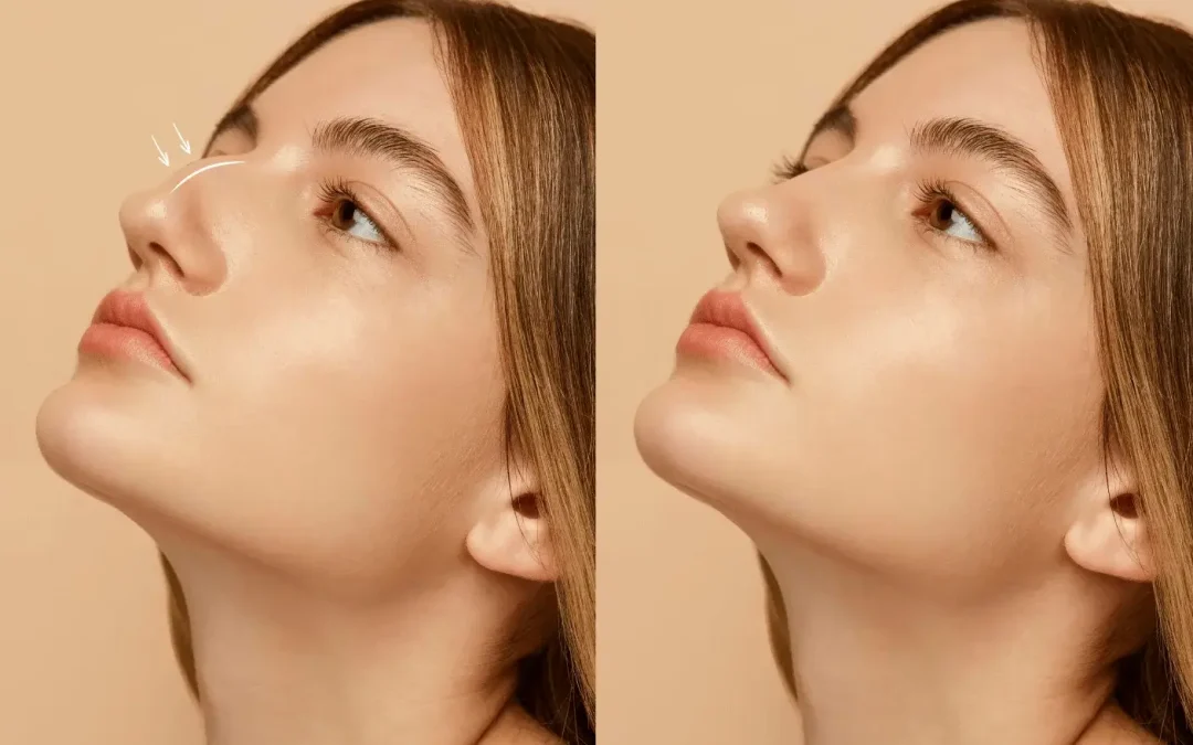 Thick Skin Bulbous Tip Rhinoplasty Turkey