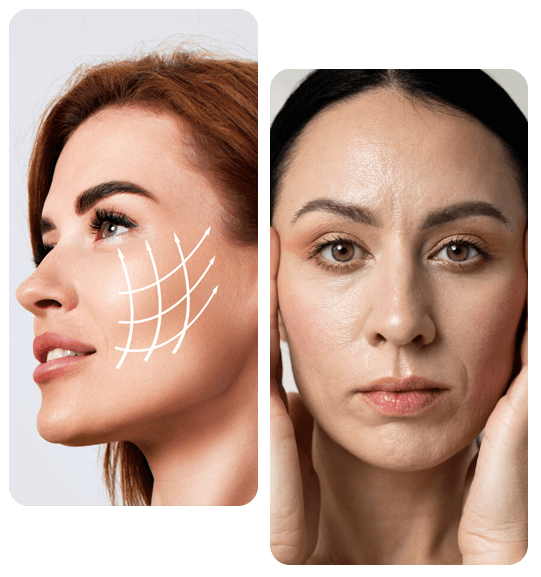 best candidate for subperiosteal facelift